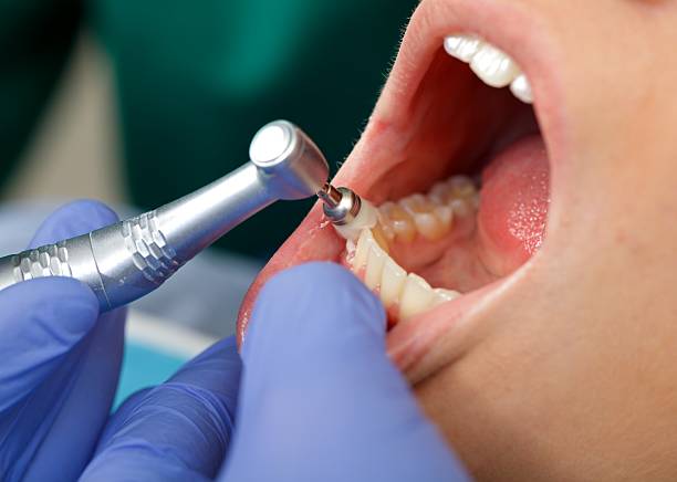 Best Tooth Extraction  in USA